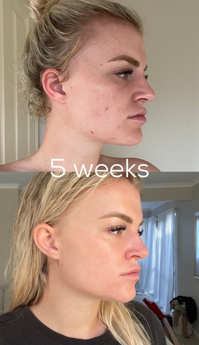 8 WEEK Skin Transformation program